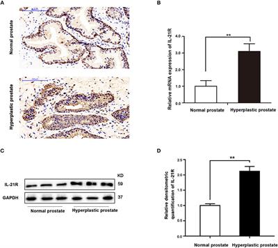 Upregulated Interleukin 21 Receptor Enhances Proliferation and Epithelial-Mesenchymal Transition Process in Benign Prostatic Hyperplasia